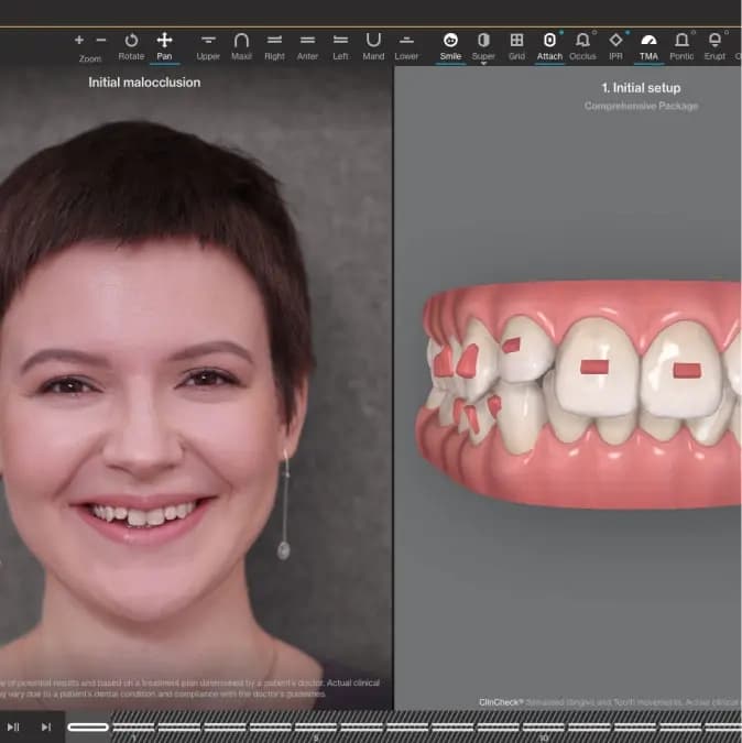 Invisalign® technology with 3D visual interface